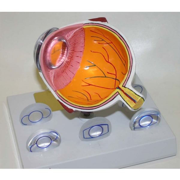 Intra Ocular Lens Model and IOL Lenses – Akriti Ophthalmic