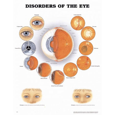 Eye Classification Disorders of Eye Anatomical Chart – Akriti Ophthalmic